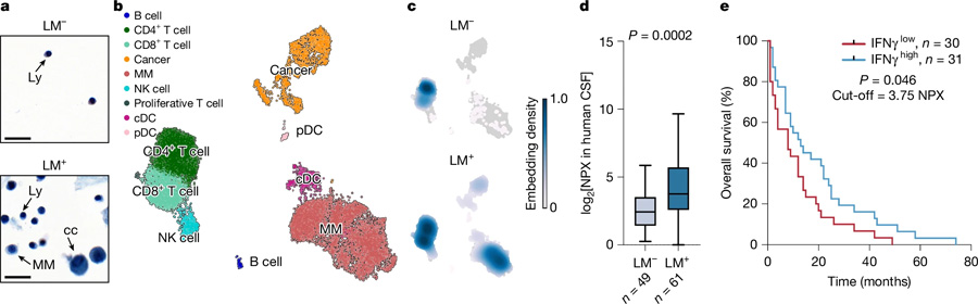  炎癥誘導的腦脊液細胞增多見于軟腦膜轉移患者