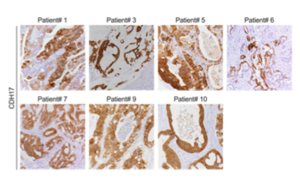靶向鈣黏蛋白17(Cadherin-17/CDH17)的CAR-T細胞系統性遞送策略：安全有效治療結直腸癌肝轉移的新突破