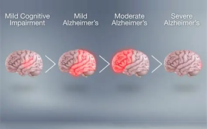 基因-代謝組-飲食互作在癡呆風險中的精準預防：APOE4純合子特異性代謝通路與地中海飲食的調控作用