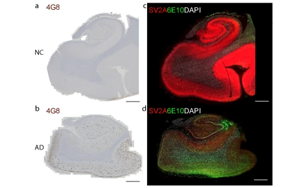阿爾茨海默病中突觸囊泡蛋白2A在腦組織及胞外囊泡中的減少及其與Aβ、tau和APOEε4的關聯研究