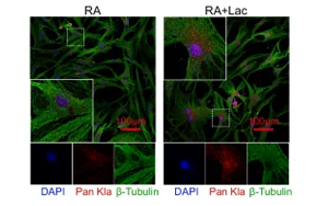 組蛋白乳酸化修飾通過上調NFATc2表達及抗乳酸化組蛋白自身抗體促進類風濕關節炎進展