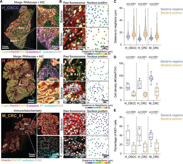 細菌感染微灶內癌細胞的空間分布 細菌感染微灶內癌細胞的空間分布